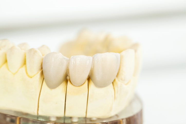 Cosmetic Dentist in Lancaster, PA Transforms Smiles with Porcelain Veneers